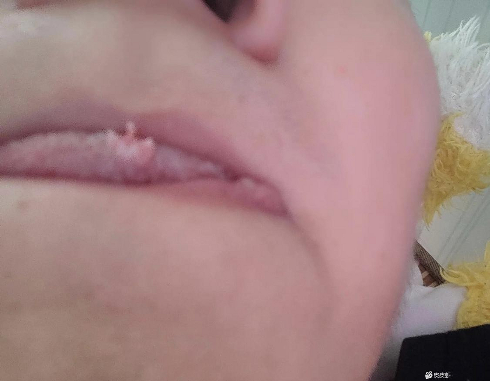 最近我舌头上长了个菜花一样的东西,有没有人知道这是啥啊