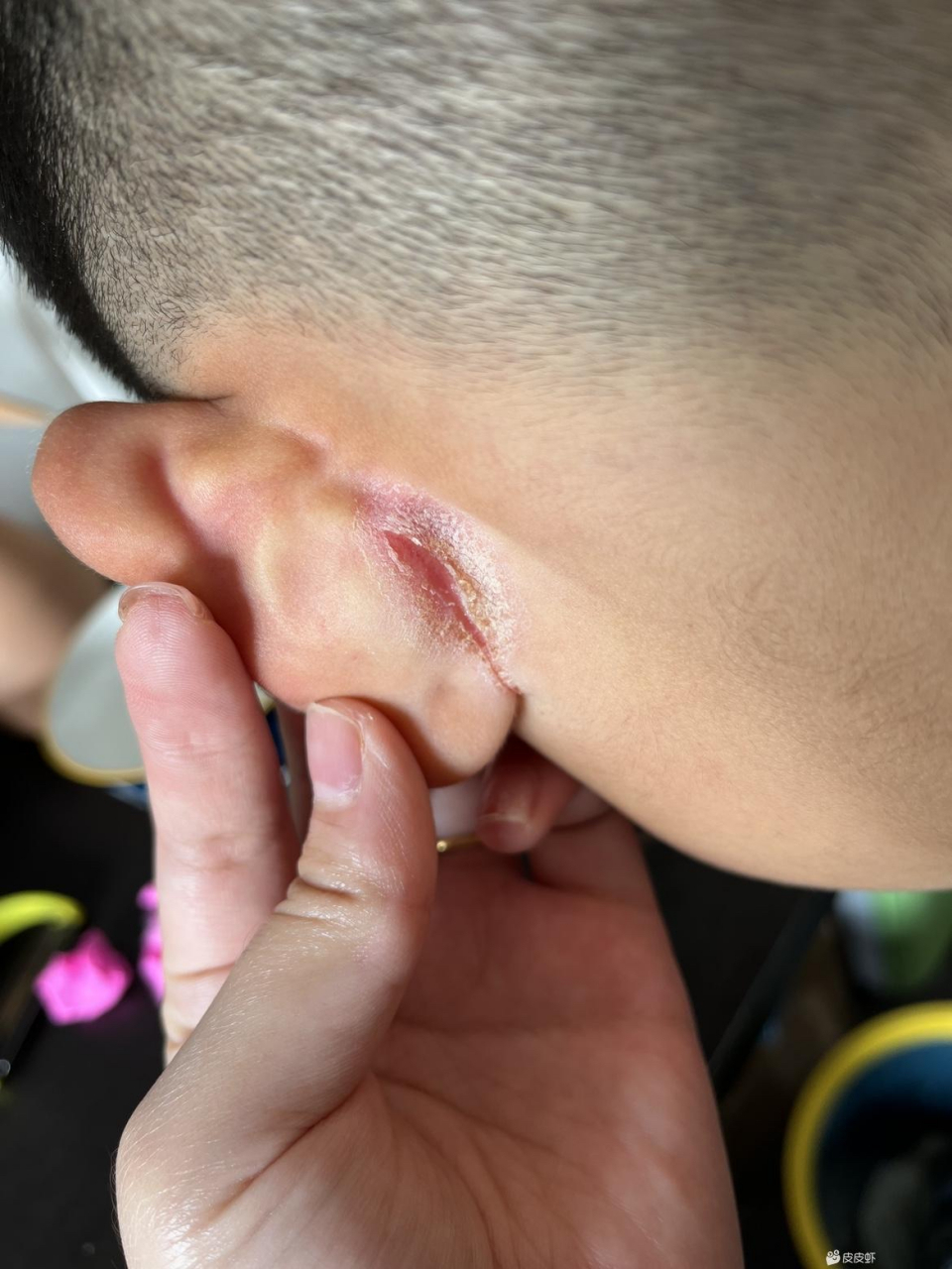 网友们,最近耳朵裂开了,有没有知道这是啥?疼死我了[流泪]