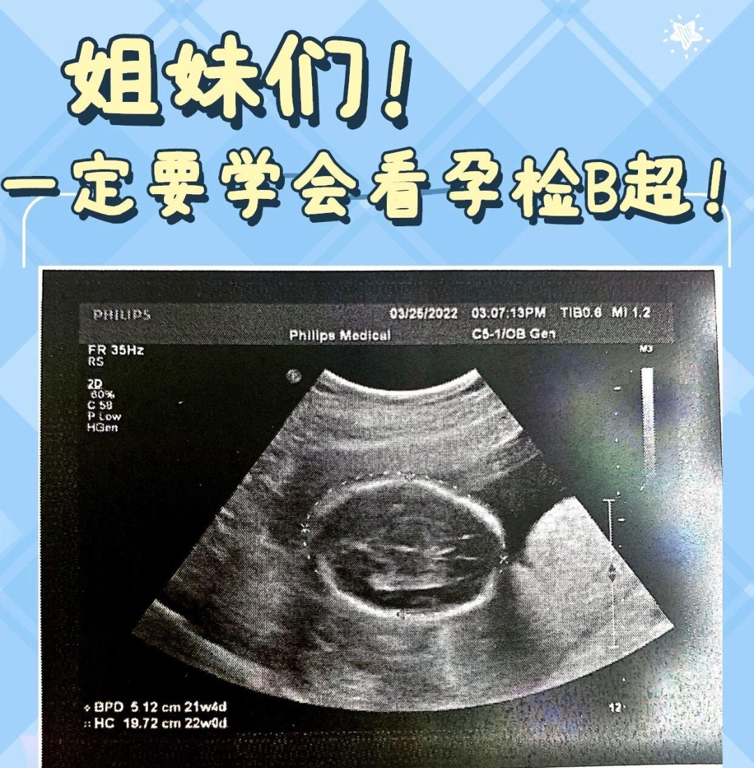 跪求孕期一定要学会看孕检b超