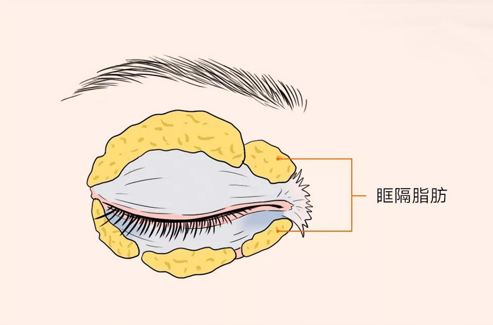 那麼能通過眼霜去除眼袋嗎? 我可以明確的跟你說:不能!