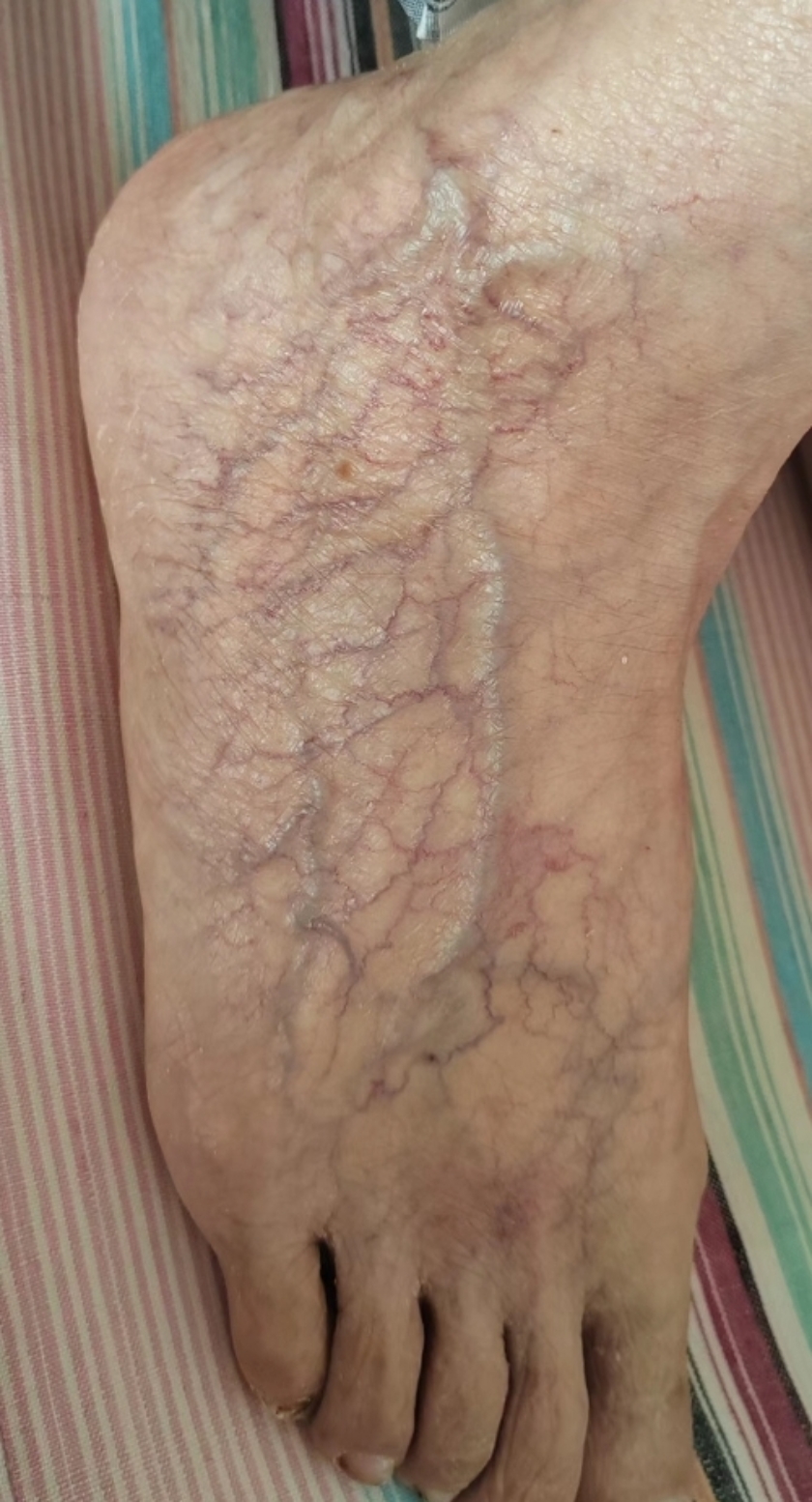 老人脚上这样是怎么回事?