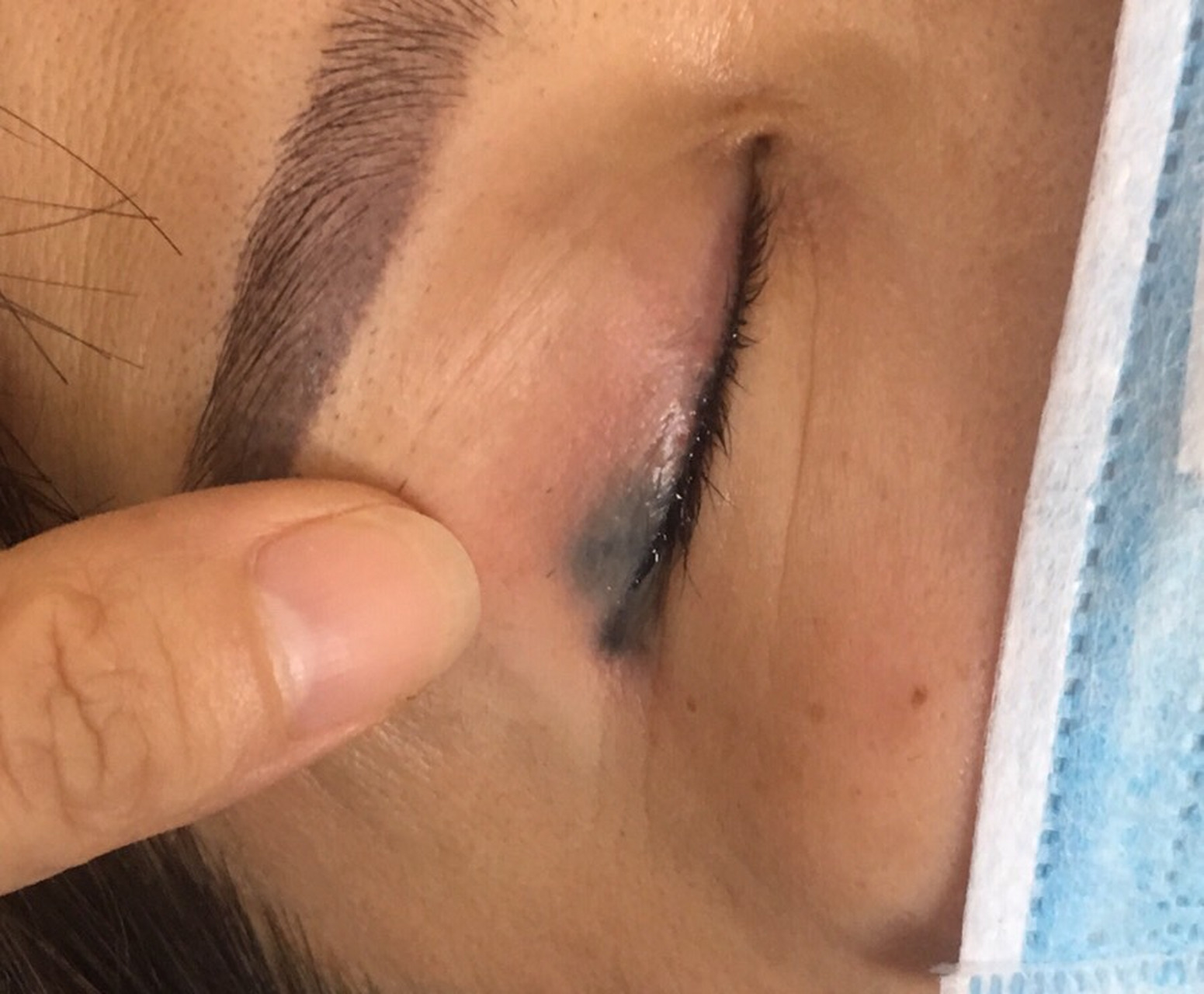像这种纹眼线晕色的地方激光能洗干净吗?