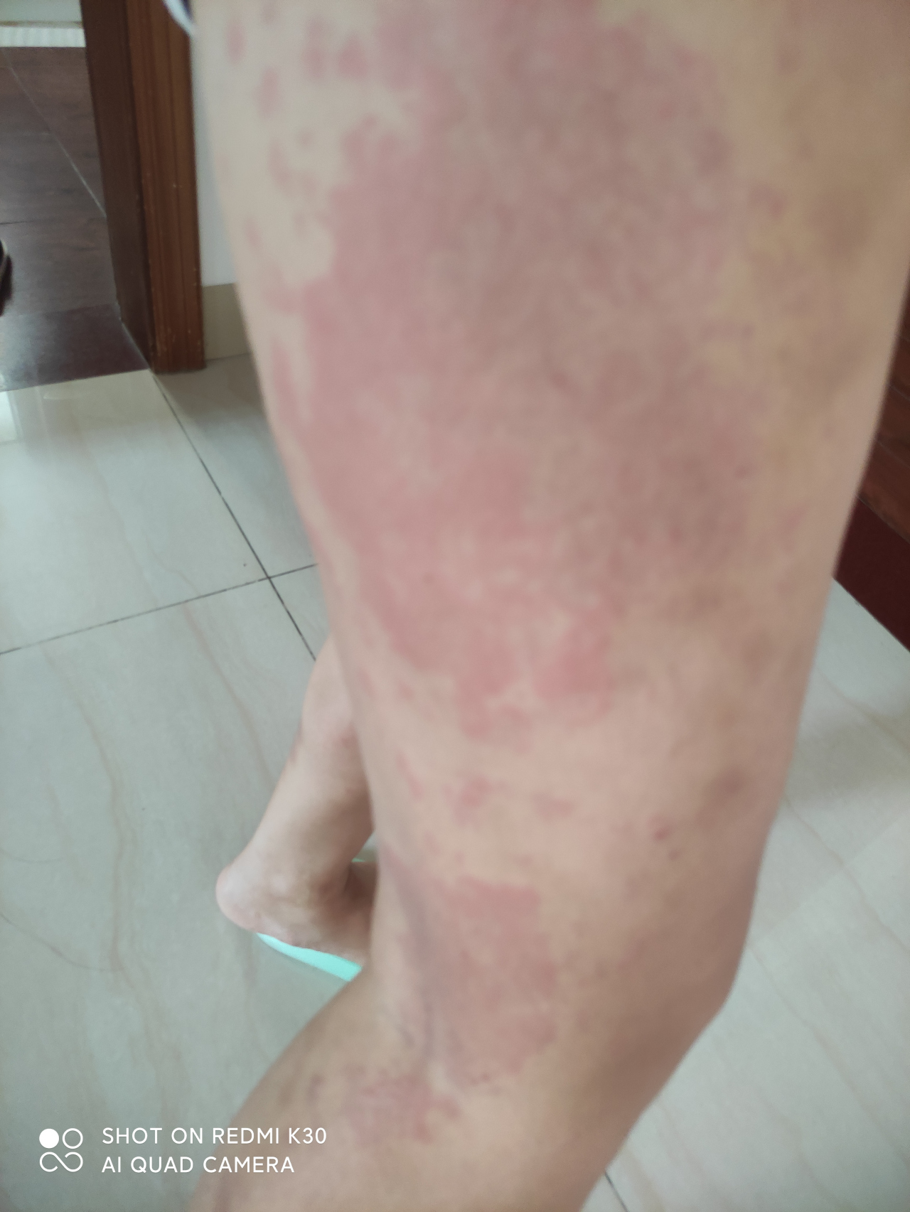 严重荨麻疹