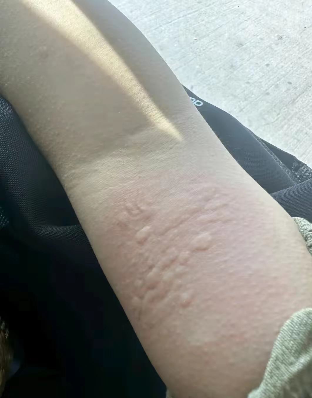 风团图片和症状图片风团样疙瘩图片荨麻疹样子的图片荨麻疹图片风疹