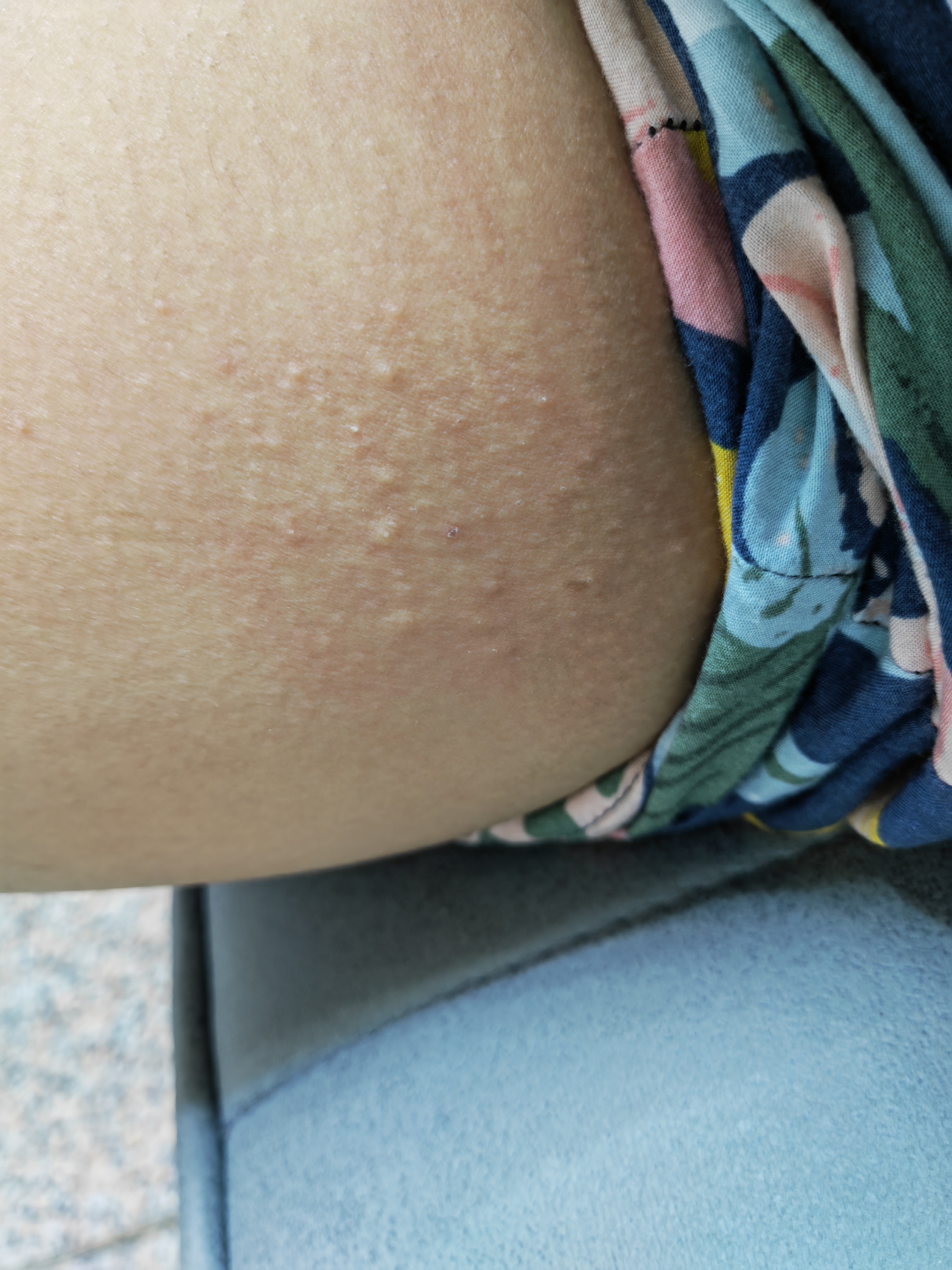 大腿内侧突然长了一堆这样的东西垦请伟大的朋友圈给予帮助十分感谢