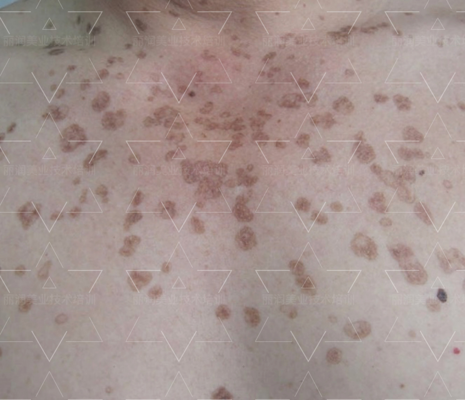 皮肤角化症治疗方法图片