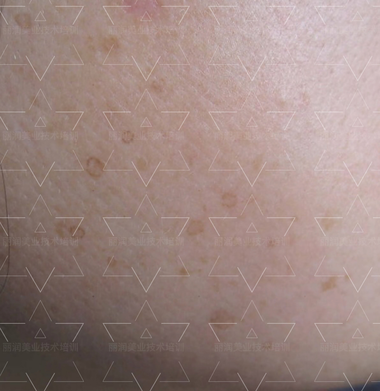 何为空心斑～ 也叫汗孔角化症, 是一种少见的遗传性皮肤病,无自觉症状