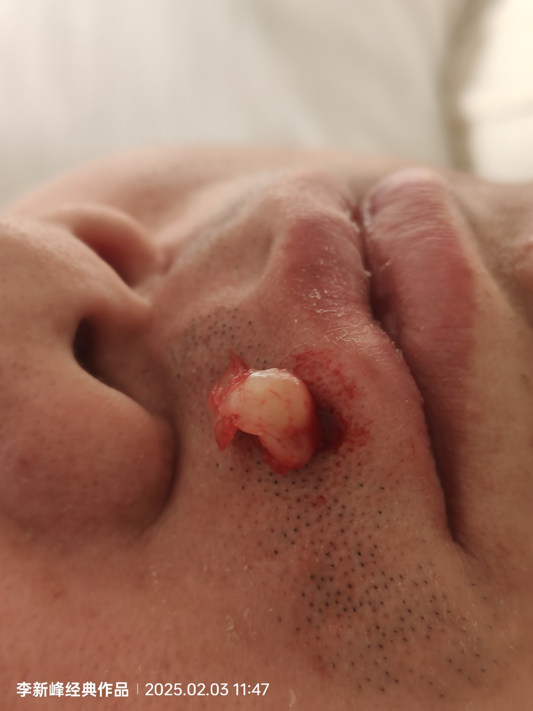 今天第二位帅锅嘴唇上长了一个小筋肉瘤#脂肪瘤# #纤维瘤# #腮腺肿瘤