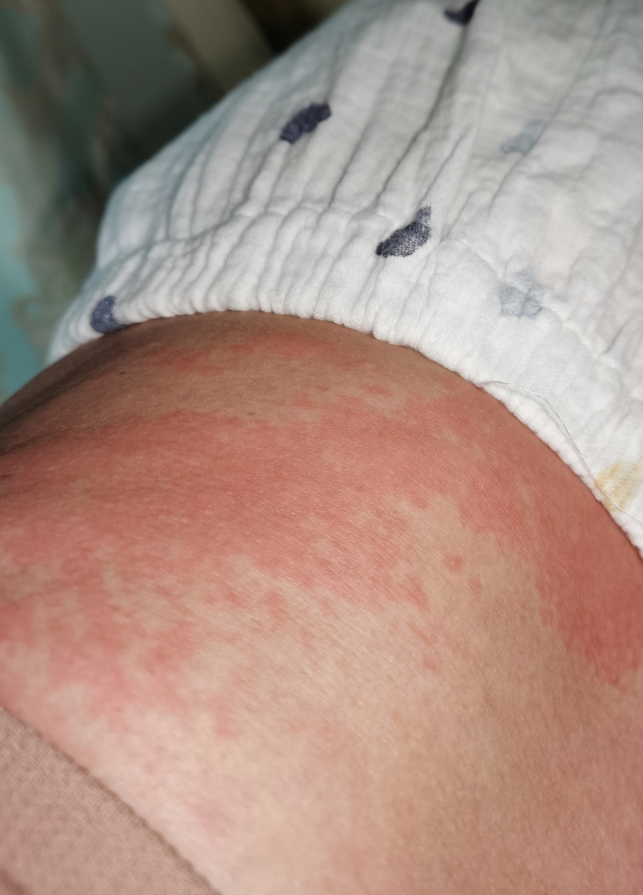 打新冠疫苗全身痒,起疹子 开始还以为是蚊子咬了在手臂上,没注意,晚上