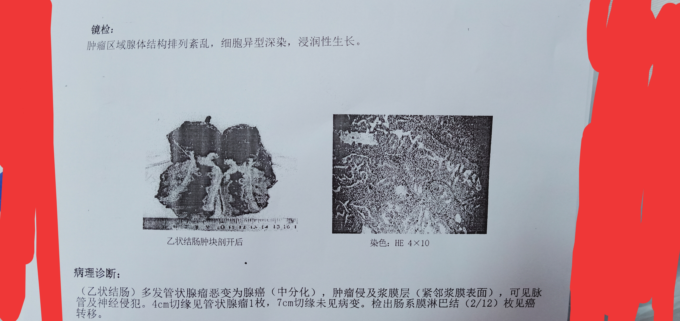 我33岁,病理切片结果是结肠癌,医生说是还有救的那种癌,请问这是几期
