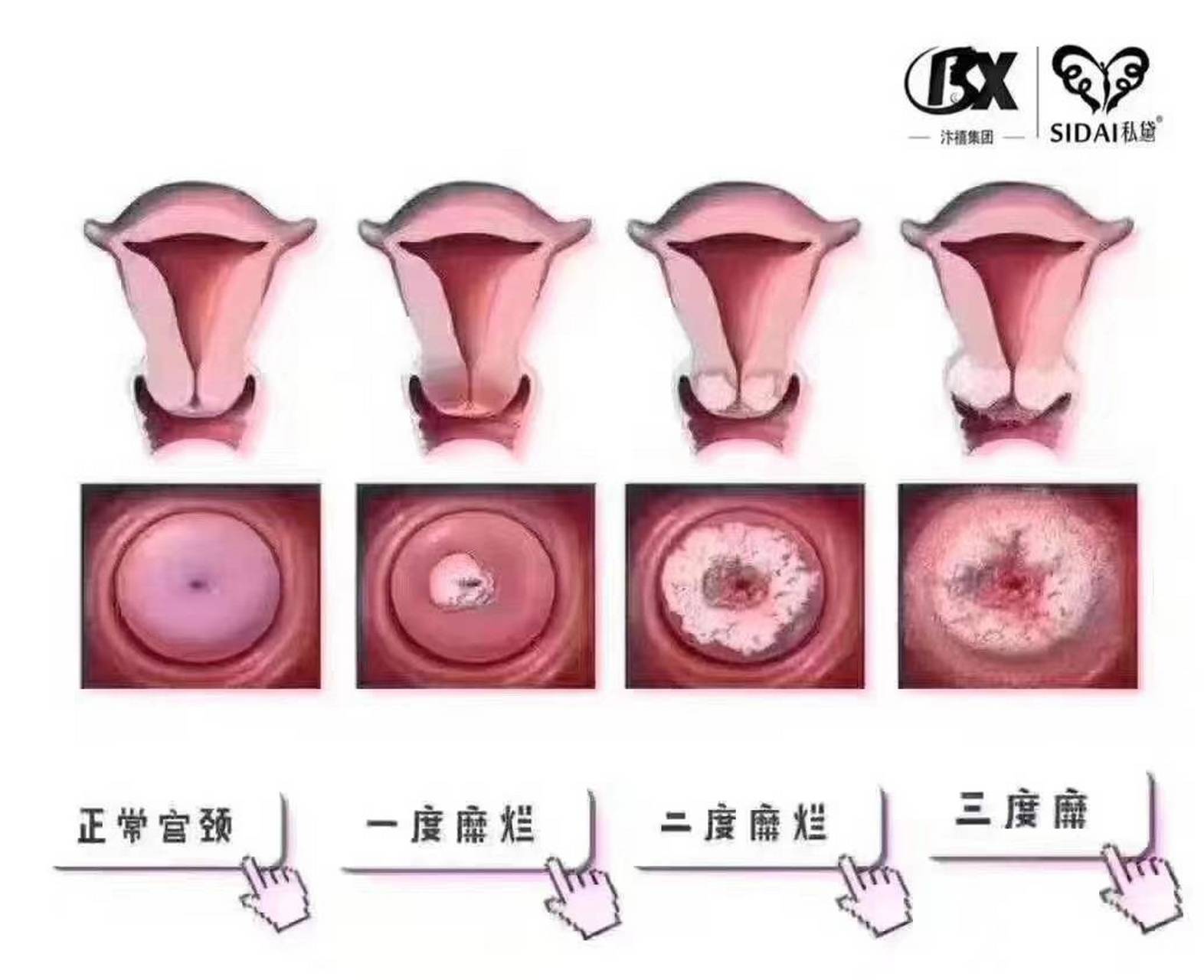  "宫颈糜烂"小识知分享 . 1.