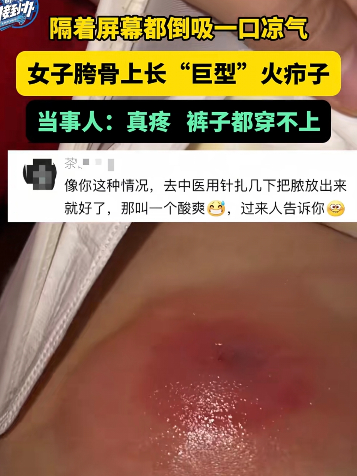 大腿肌肉囊肿图片图片