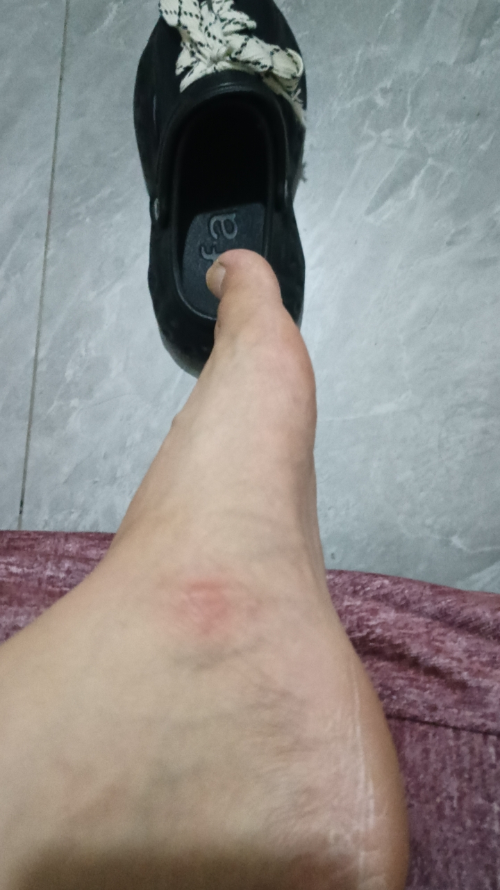 第一次买的鞋子 ,居然不是磨脚指头和脚后跟,而是这个地方,疼