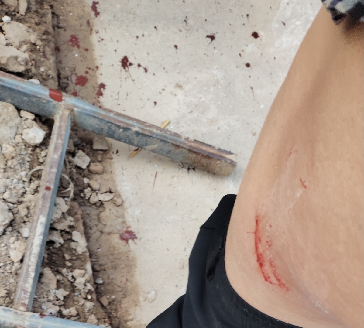 轻伤不下火线,说的便是现在的工地,甚 破伤风伤口脚被钉子扎了图片