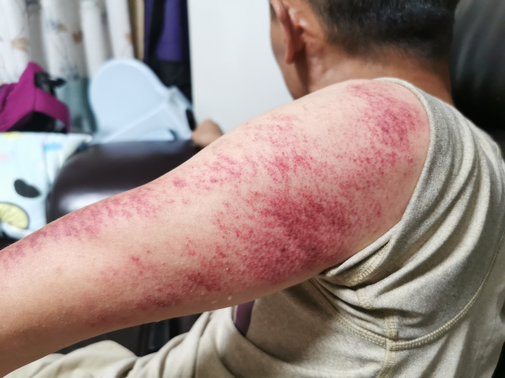 胳膊受风了 自己刮痧爽一下  破坏性疗法 ,刮得时候真的很疼 刮痧有