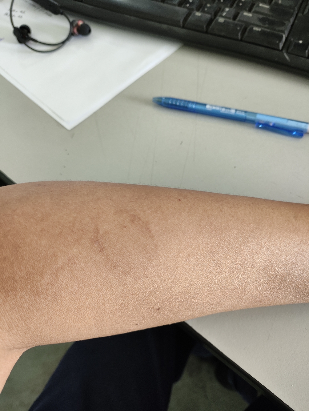 胳膊被咬后一个半月,咬痕还是这样清晰,有经历过的男同胞们吗?