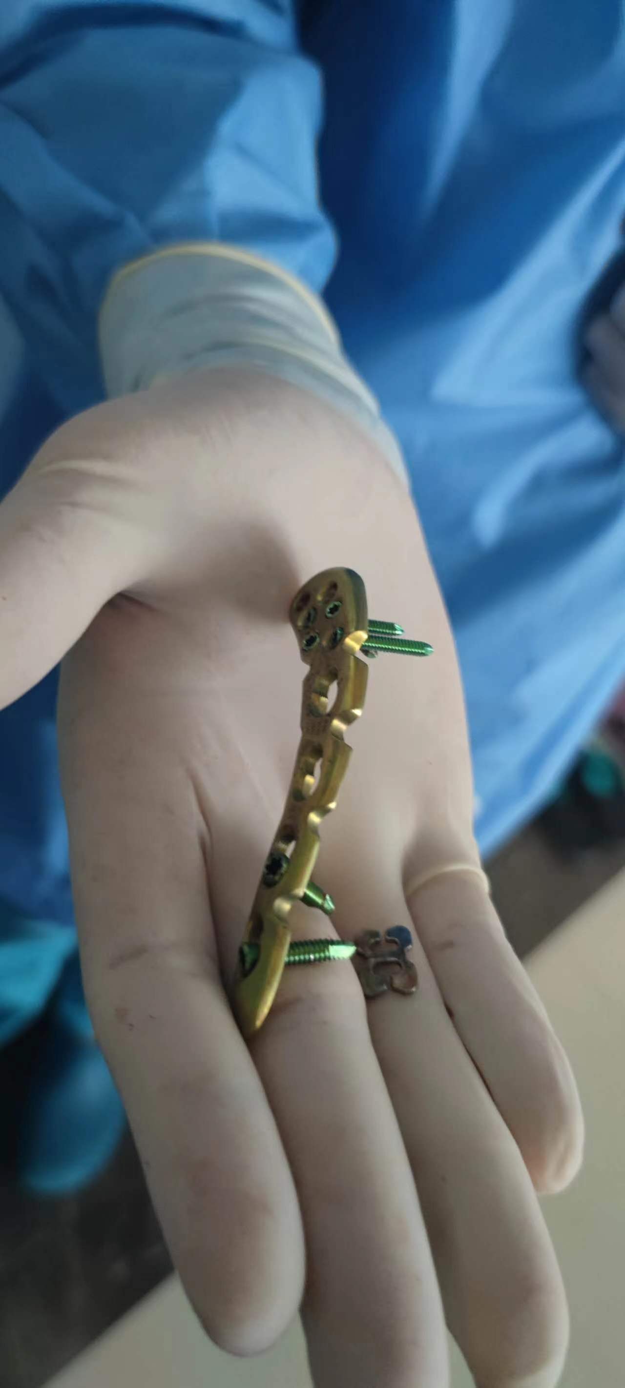 半年前的一个晚上,因醉酒骑车自己摔倒了,锁骨骨折,肋骨多处骨折