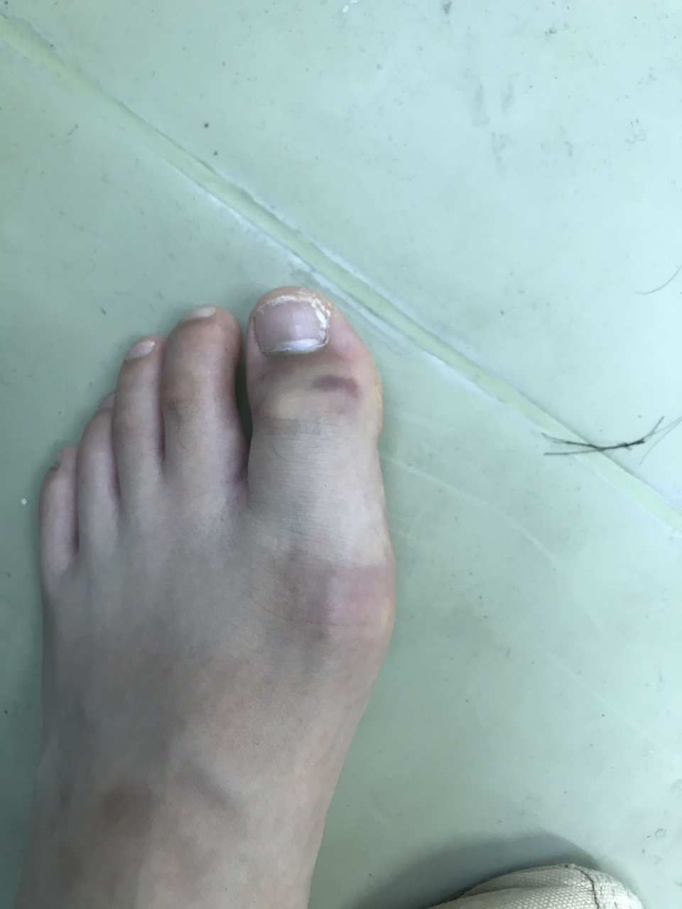 脚趾头肿胀淤血 前天早上摔了一跤但是脚趾还可以动但是很痛 下午就肿