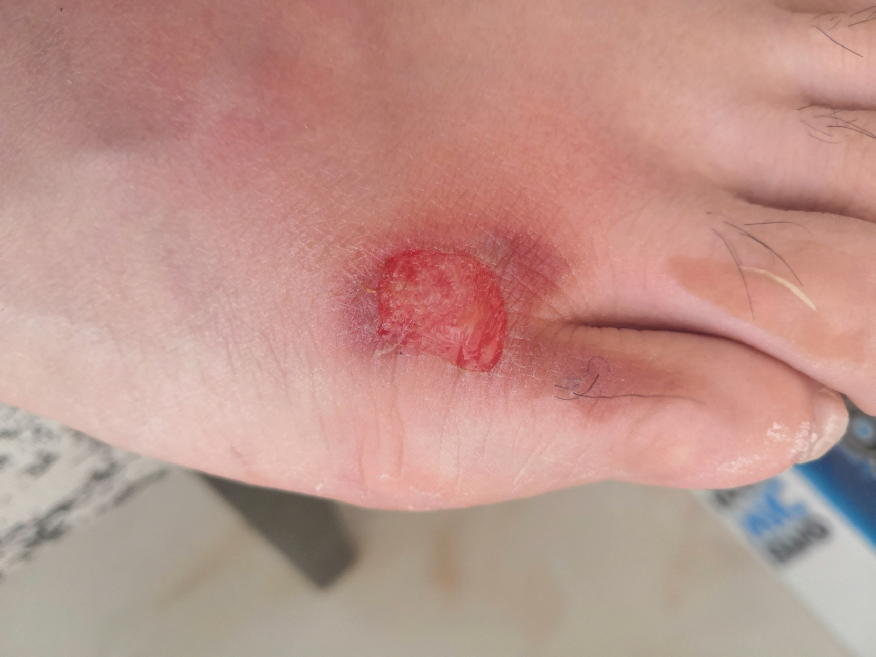 脚烫伤后,皮掉了,疼怎么处理