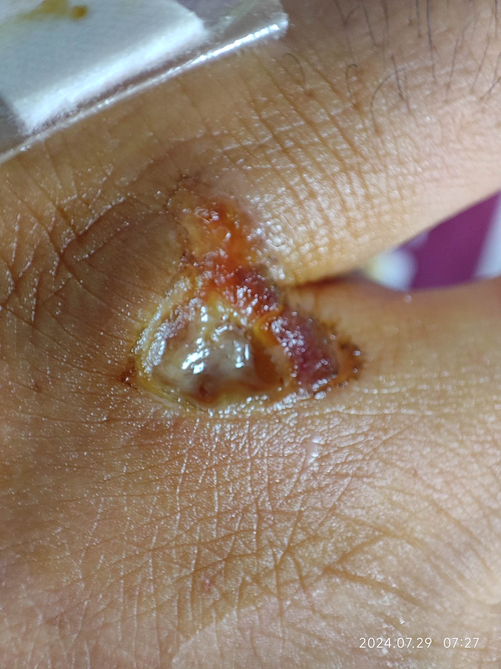 跑步摔了一跤,手受伤,伤口45天后才愈合,一碰还有点疼.