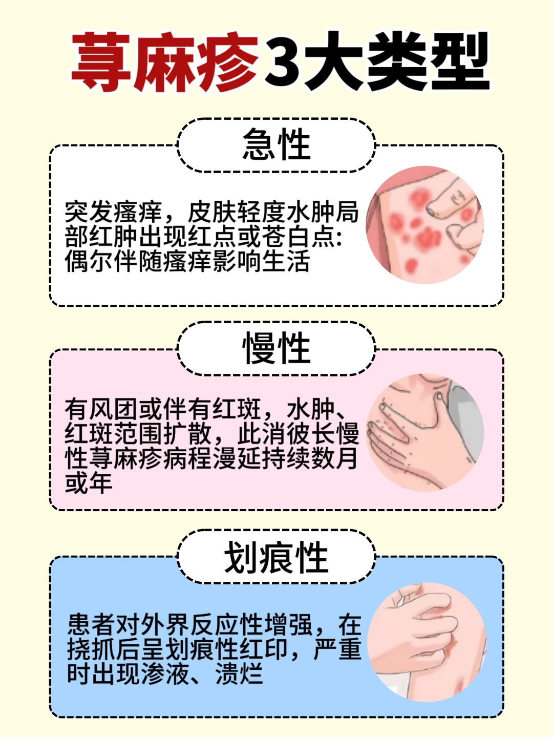 为什么产后容易得荨麻疹,服用什么药为什么在线