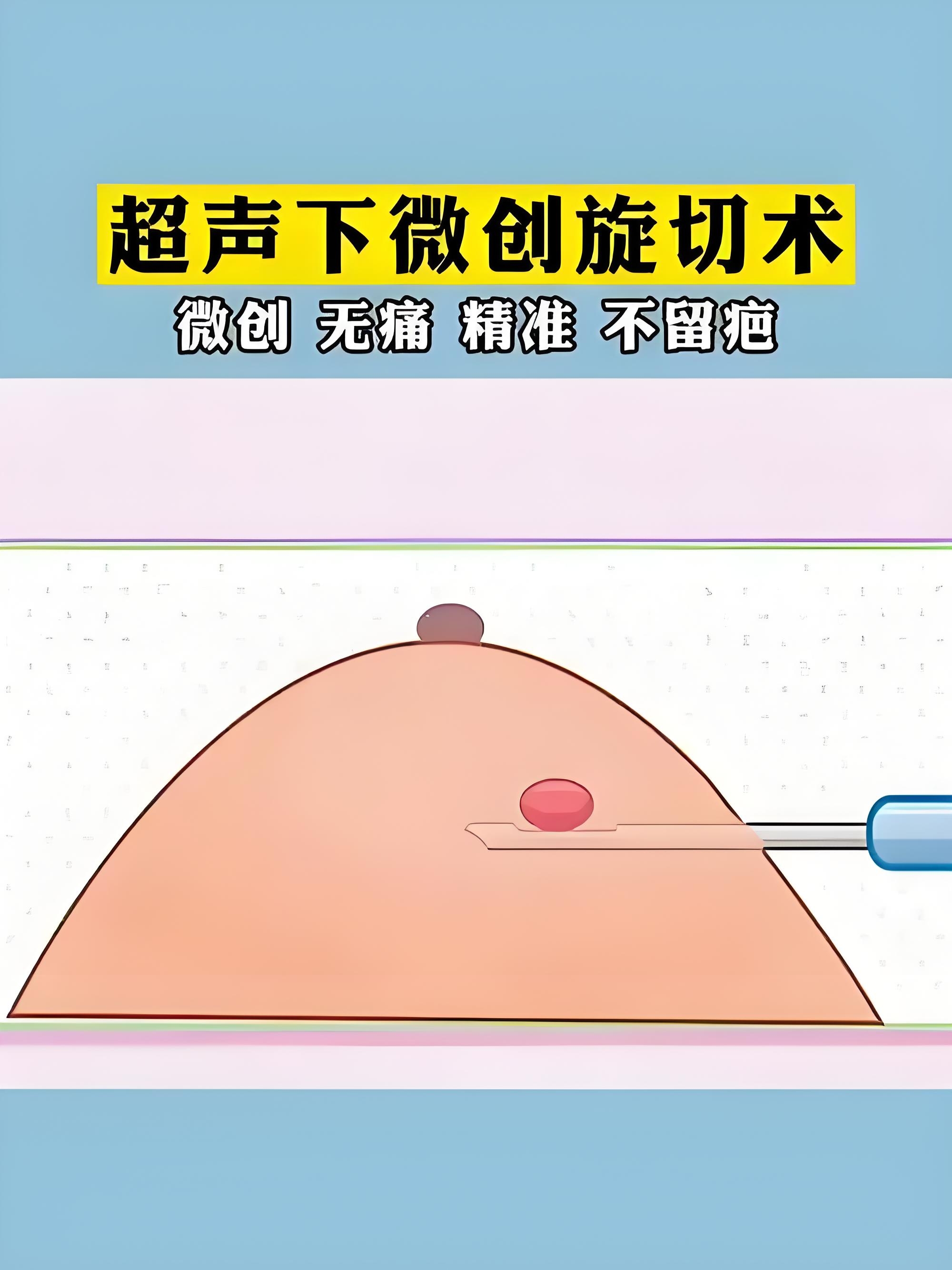 乳腺结节旋切术是什么?