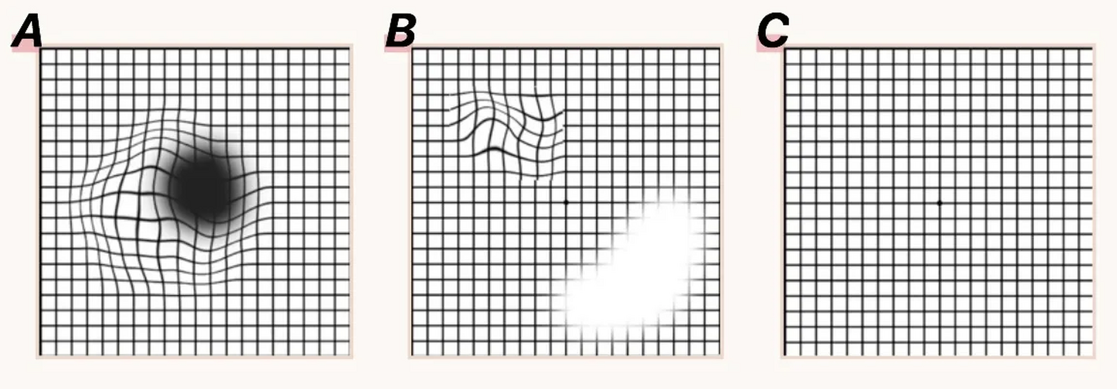 这个测试用的方格是amsler(阿姆斯勒)网格,这是眼科临床检测黄斑病变