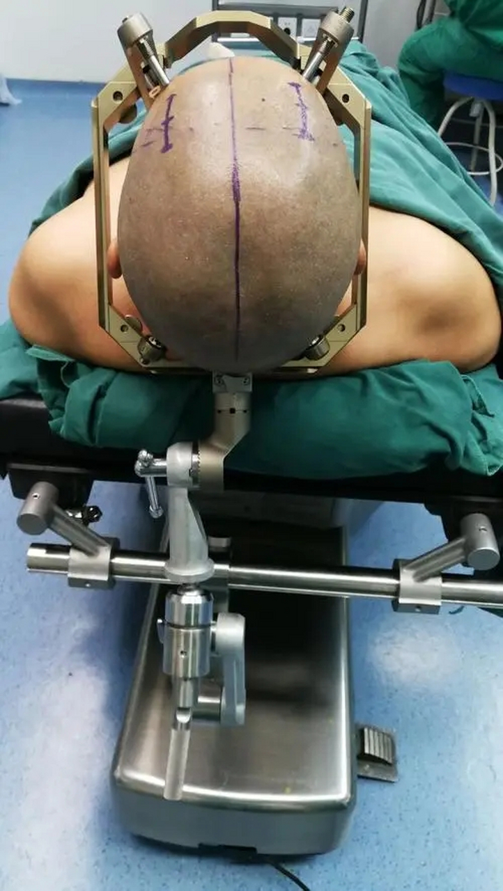 帕金森病是一种神经系统疾病,常常会影响患者的运动能力和日常生活