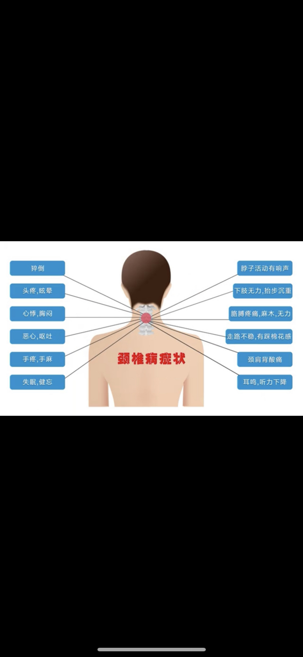 颈椎病常见症状