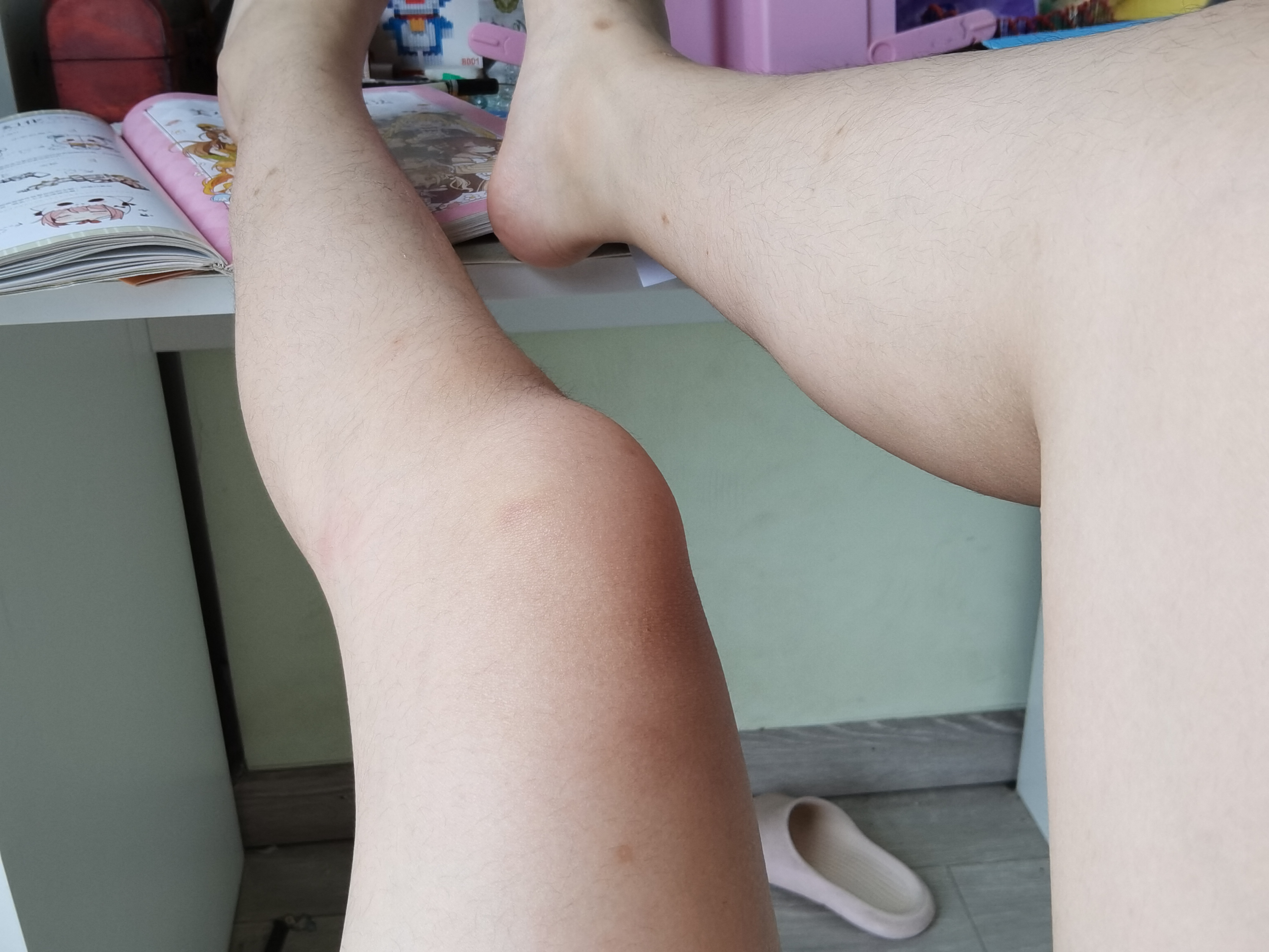 哎呀妈呀,这才半个夏天呢,我的腿上已经30多个包了.