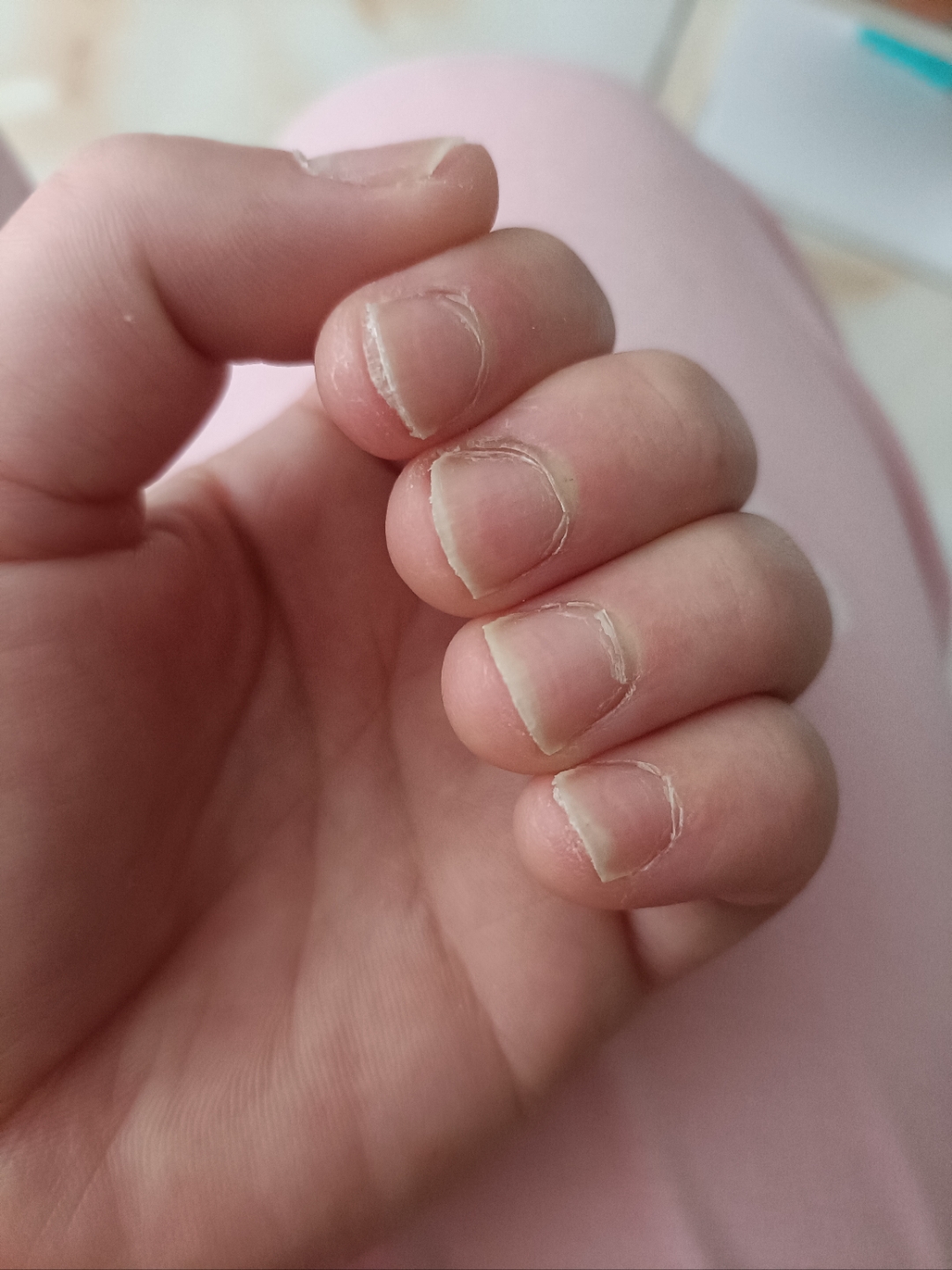 请问这是什么病啊,好多年了,指甲空,指缝夹着白色屑