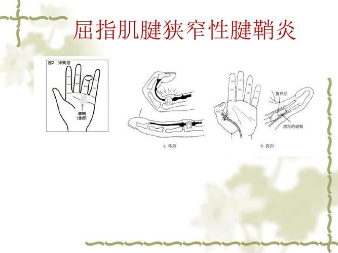 狭窄性腱鞘炎位置图片