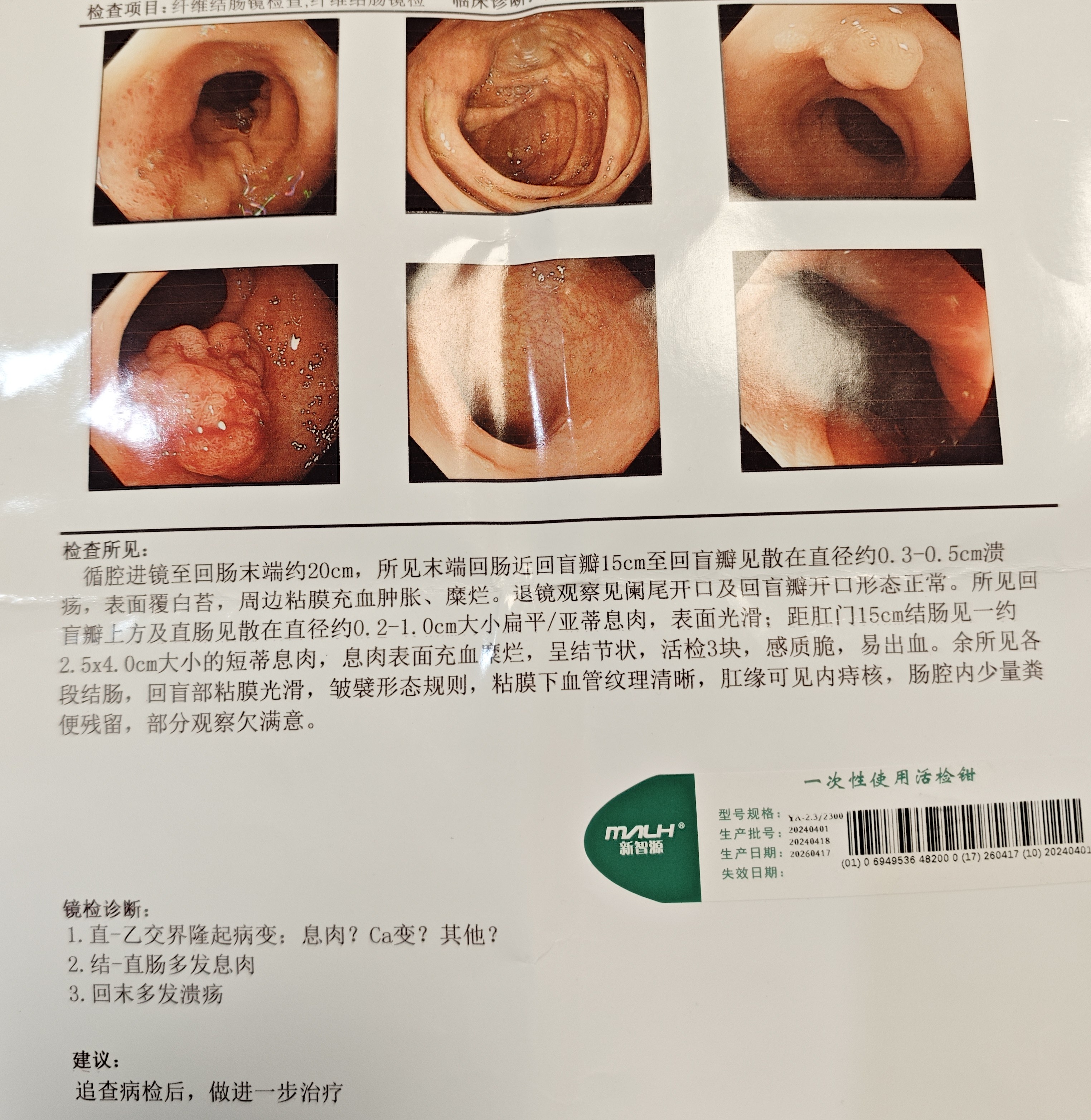 5cm,病理提示绒毛管状腺瘤,属于癌变风险极高的类型,住院行内镜下病灶