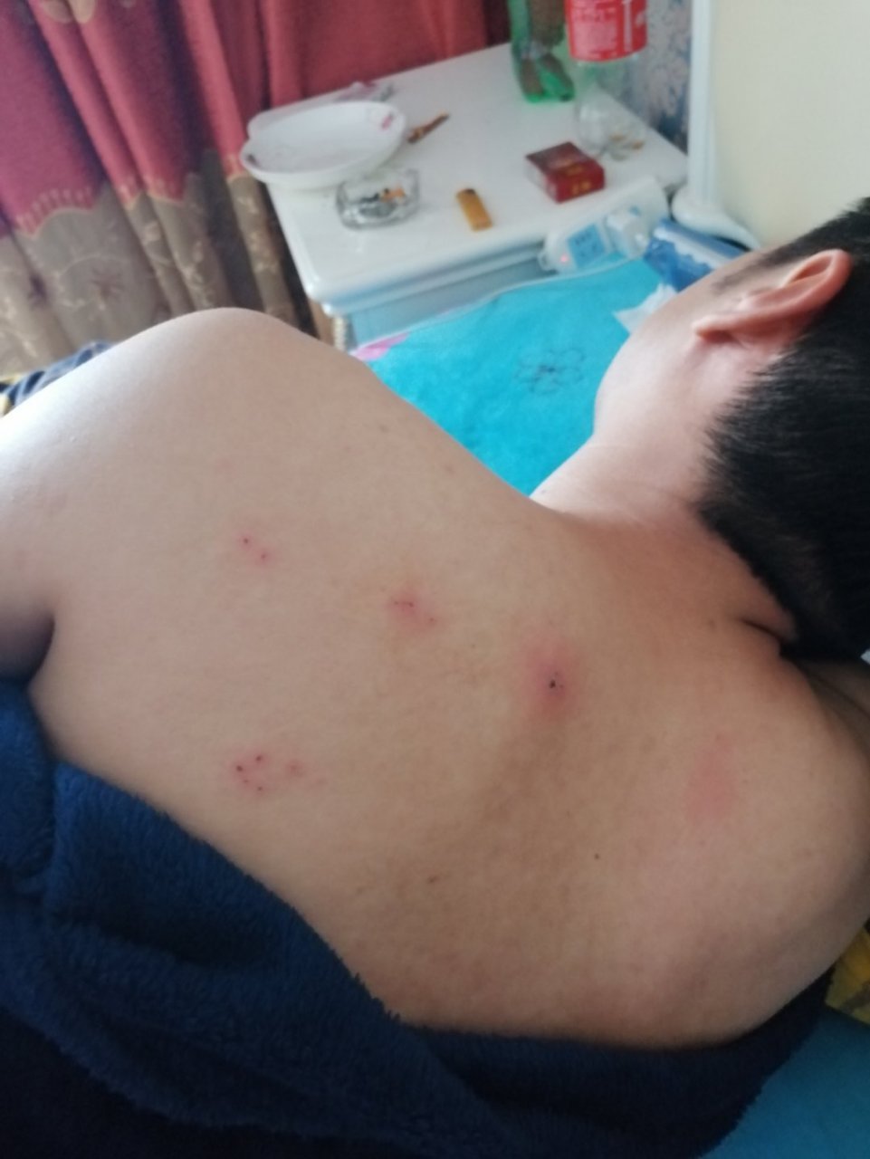 后背无缘无故起了几个红疙瘩,有没有起过这种疙瘩的