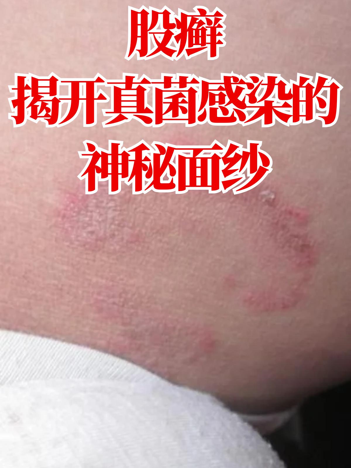 股癣:揭开真菌感染的神秘面纱 股癣,是发生在腹股沟,会阴,肛周和臀部