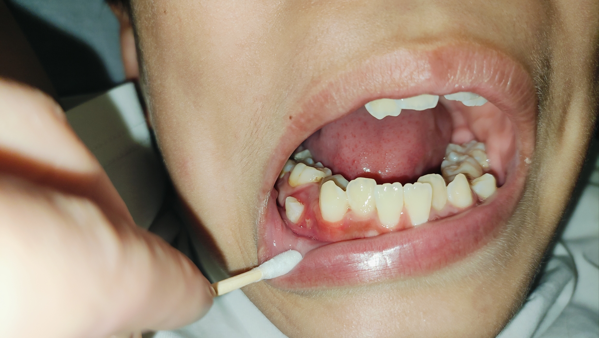 这种牙齿是什么情况?有两颗横着长还有长在外面的,剩下的全是坏的