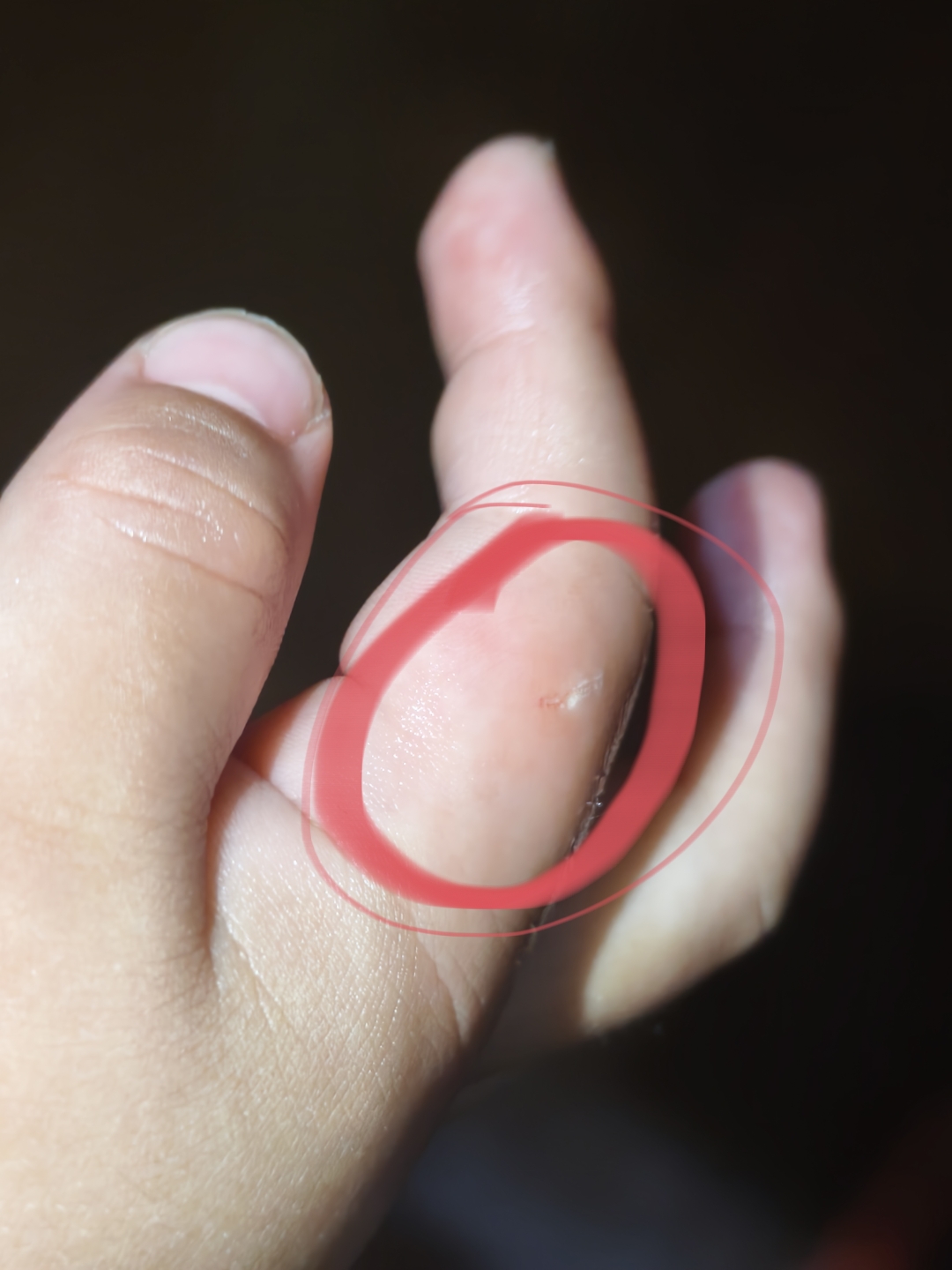 今天晚上出去玩,在超市门停车场,宝宝手被流浪猫抓破皮出血了,要不要