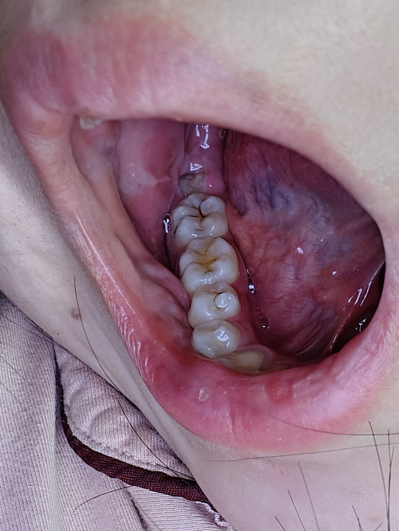 我前天拔了左侧的智齿,来记录一下拔智齿的变化,下面是我没拔智齿前的