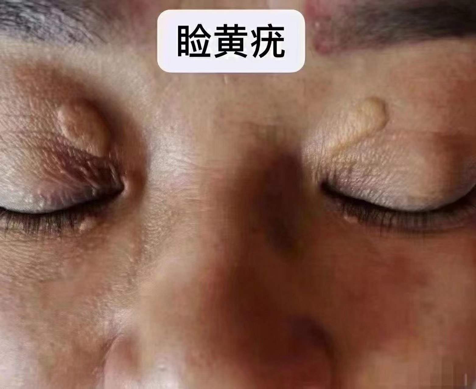 睑黄疣又称睑黄瘤 是黄瘤中最常见的.