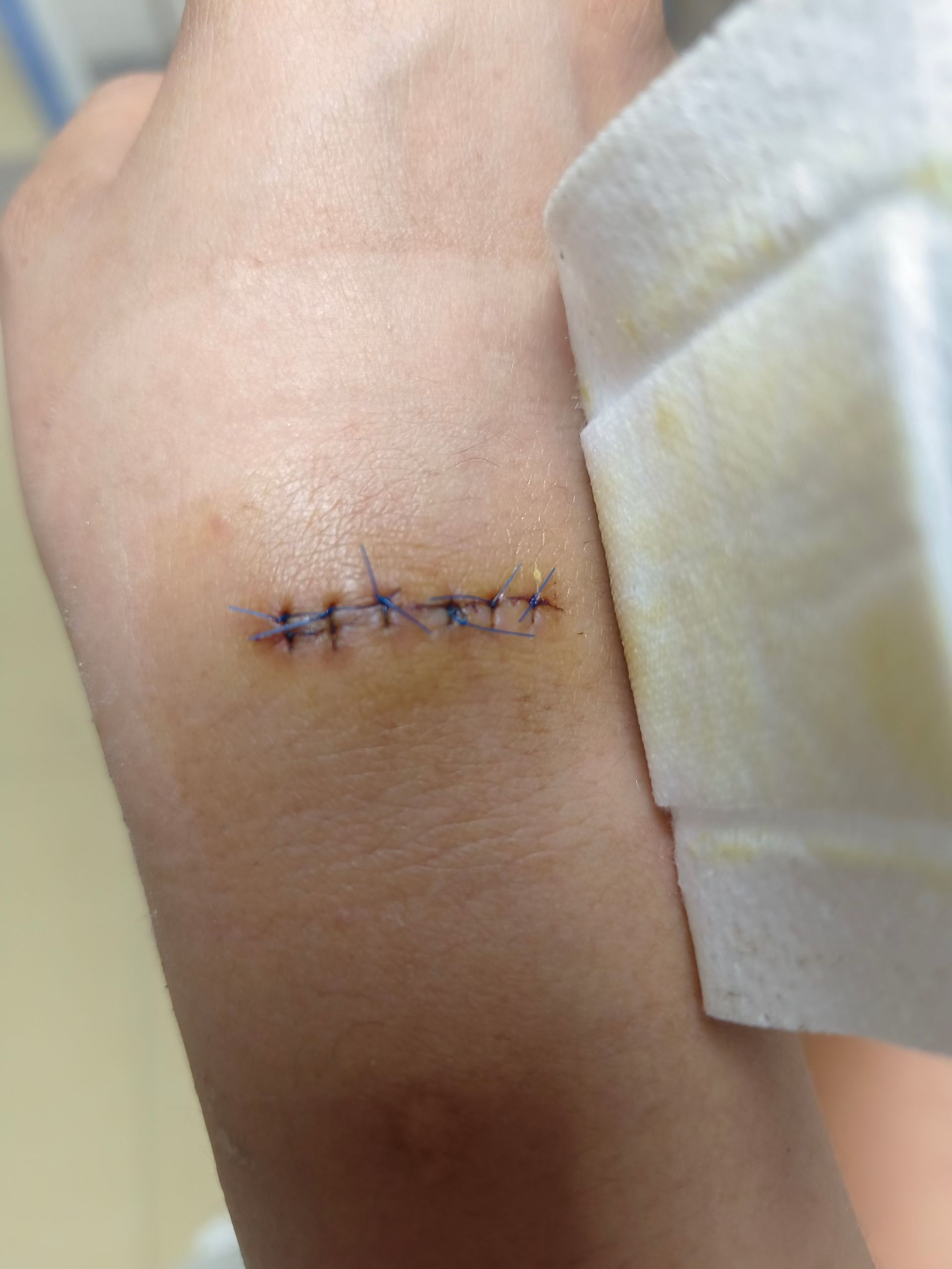 腱鞘囊肿手术14天拆线,我的缝的比较紧,线比较细,拆线时疼