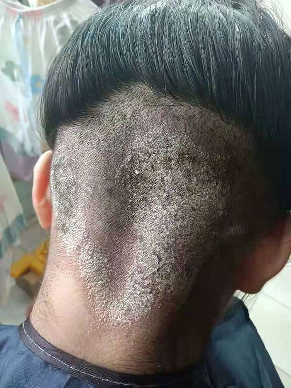 头癣 16岁的女孩,感染头癣多年 终于解决了她的难题,恢复自信#头癣