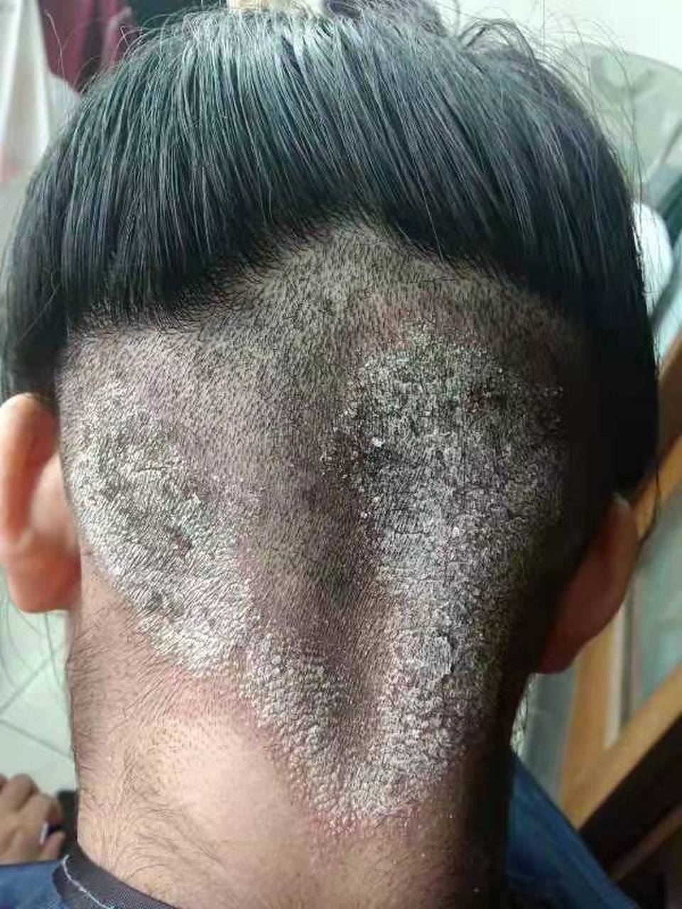 头癣 16岁的女孩,感染头癣多年 终于解决了她的难题,恢复自信#头癣