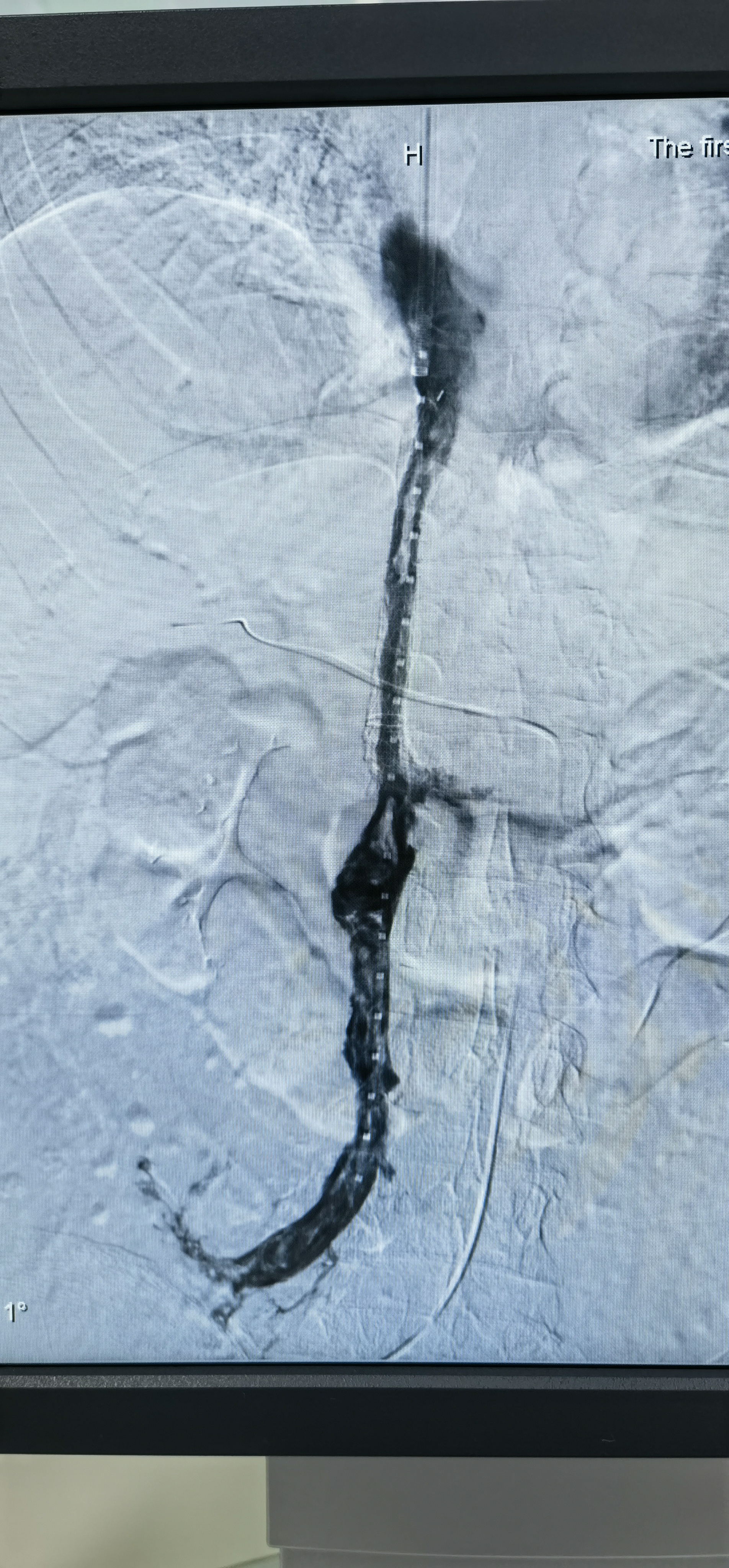 门静脉广泛血栓形成,进展往往很快,死亡率很高.在最短的时间发现问题,