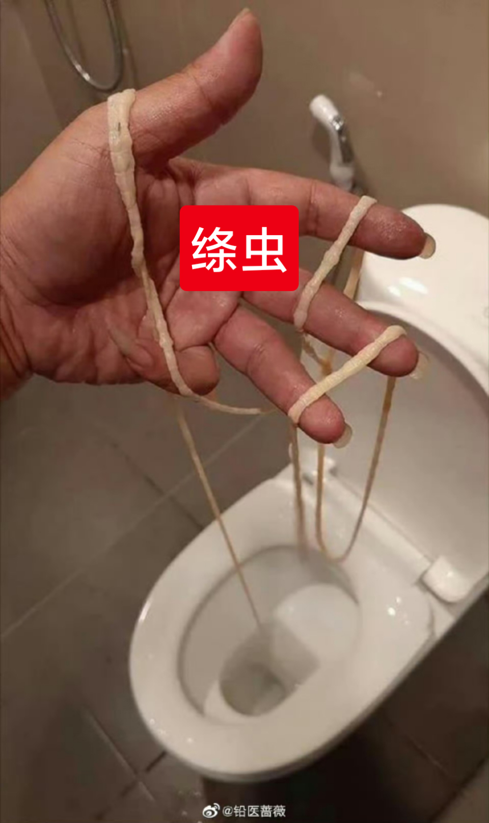 女子吃生菜卷肉体内取出20厘米蛔虫#健康人无需每年吃打虫药,现代