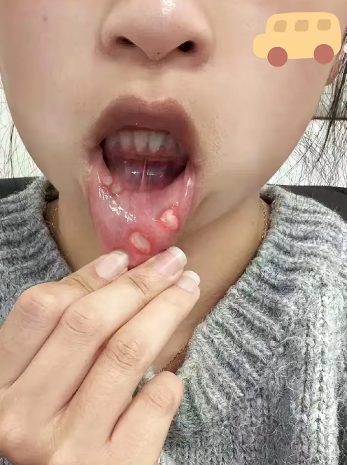 朋友们,我的口腔溃疡已经十多天了