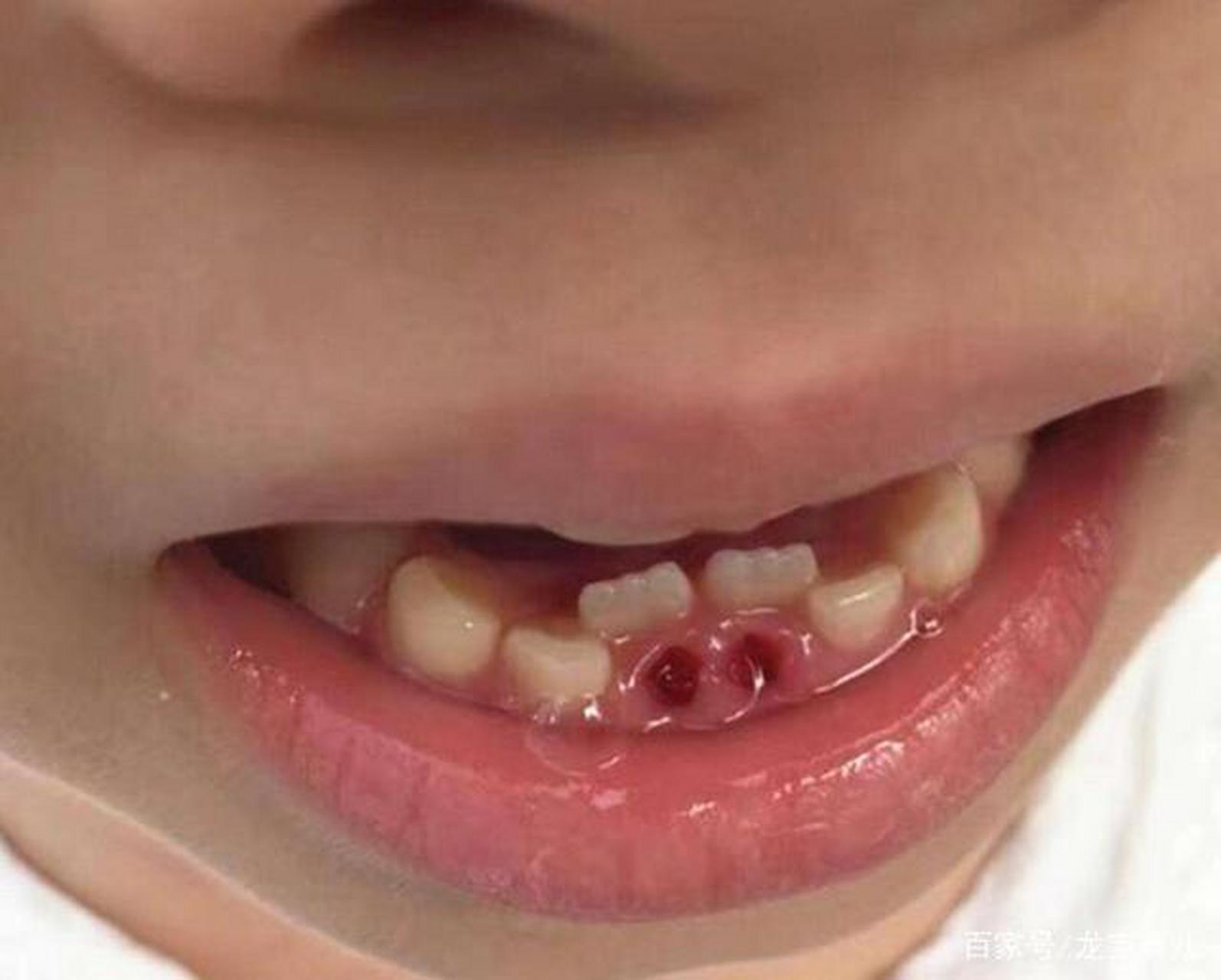 如果恒牙萌出后,乳牙没有自动脱落,出现了双排牙的时间较长,而且