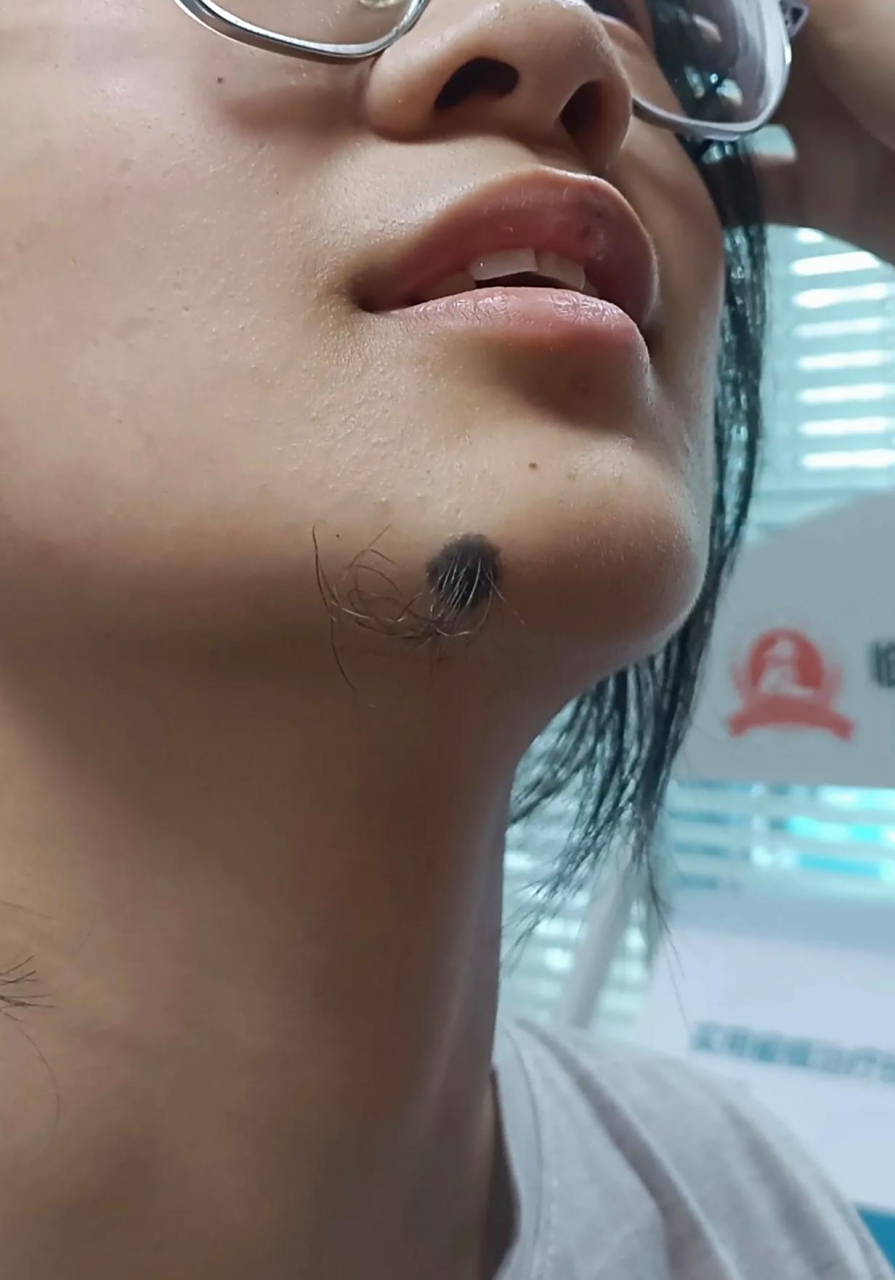 可是好多人见了都说是个有福的痣,不要动它