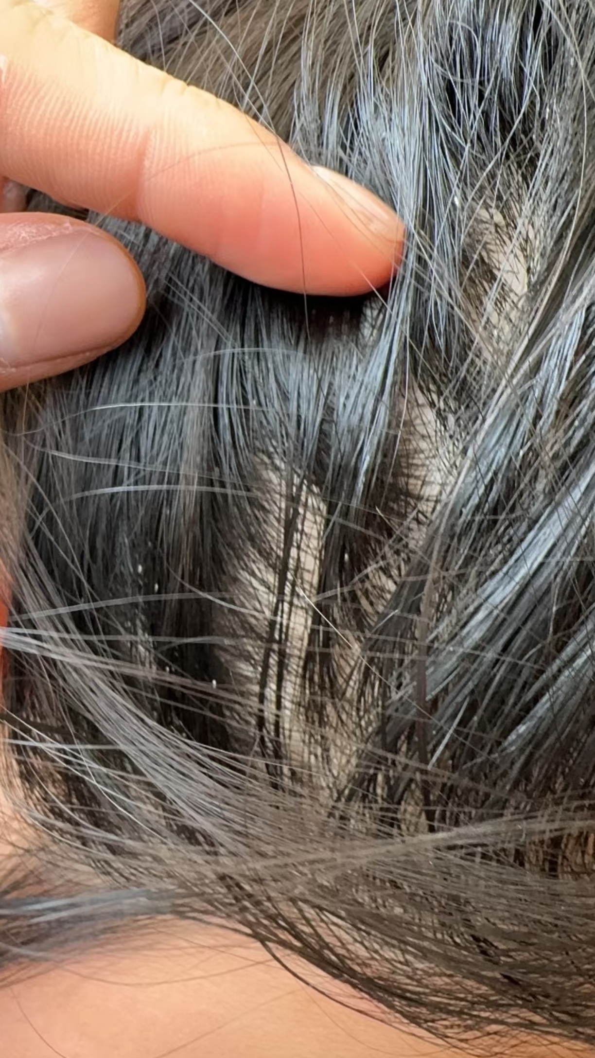 头虱是一种小型扁平无翼昆虫,专门寄生在人体头皮上,靠吸食皿液为生