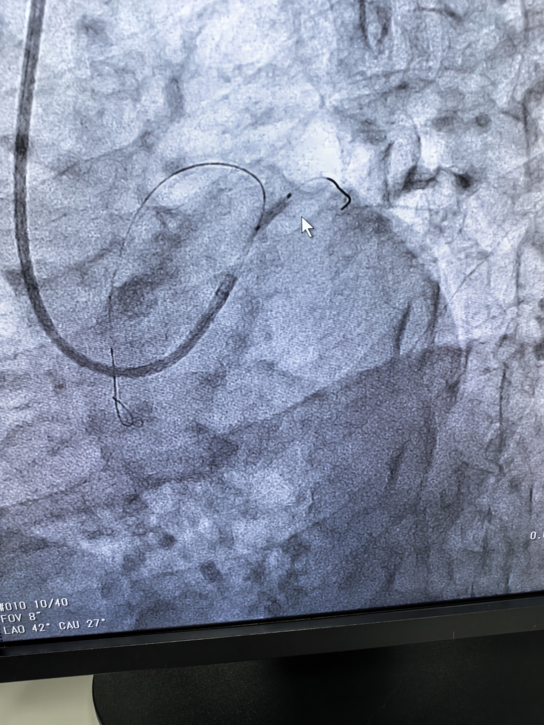 狭窄达99%,以球囊扩张后行血管内心脏血管堵塞百分之八十ct片子图片左