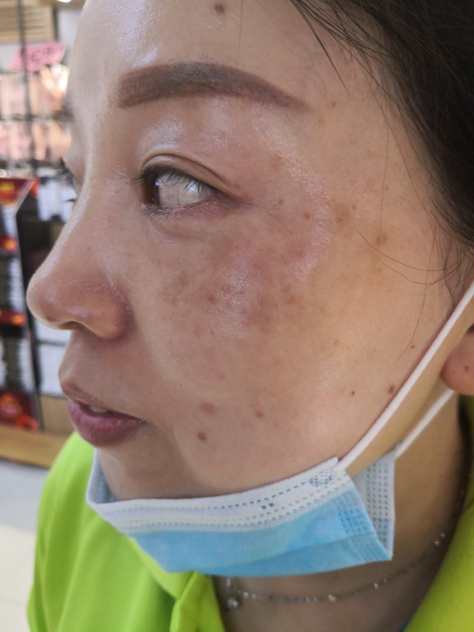 这是我激光祛斑后三个多月后的图片,黑色块状这个今后还有可能淡化吗?